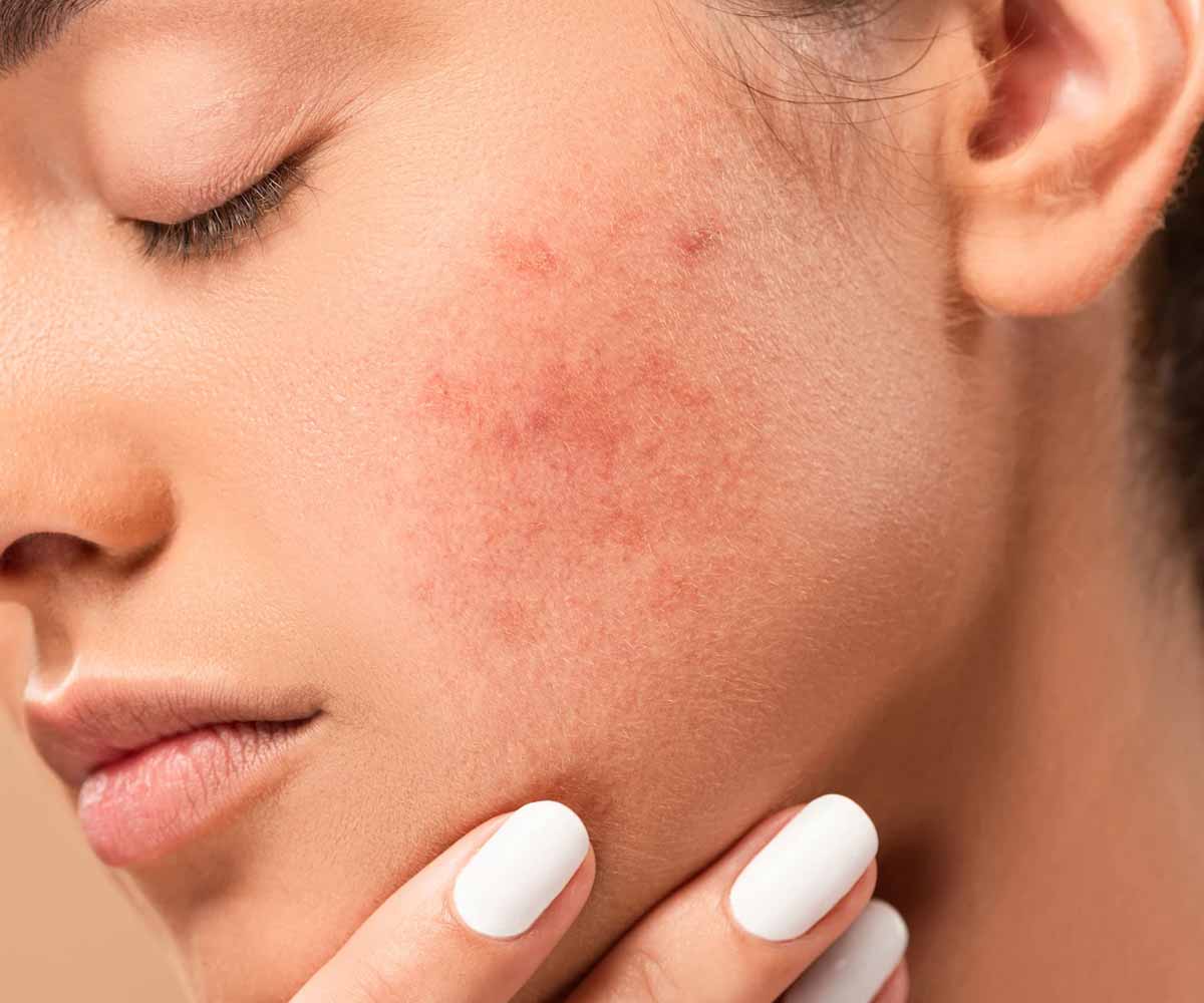 آکنه و جوش دلایل به وجود آمدن + روش درمان